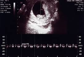 Being 6 weeks pregnant represents actually 1 month since conception and 6 weeks from the last menstruation. 10 Week Ultrasound Procedure Abnormalities And More