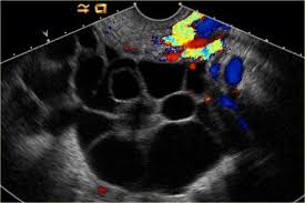 An ultrasound scan creates a picture of the tissues and organs inside your body. The Radiology Assistant Ovarian Cystic Lesions