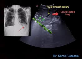 Image result for Air Bronchogram
