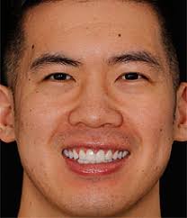 Daniel's Life-Altering Smile Makeover of Veneers and Crowns