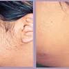 Dark or tanned skin runs the risk of pigmentation changes following the procedure. 3
