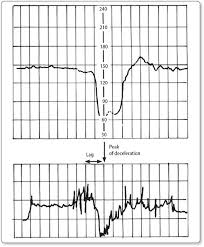 Image result for Late Deceleration