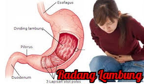 AGEN- HERBAL- OBAT -NASA -MAAG -ASAM -LAMBUNG-085231271500 