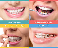 For the majority of patients, teeth straightening with dental braces may take anywhere between just 6 months and 2 years. Teeth Straightening Cost Cosmodent India