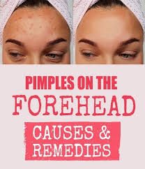 What Causes Forehead Acne And How To Treat It Pimples On Forehead Forehead Acne Cause Forehead Acne