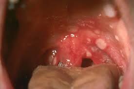 Image result for Canker sores symptoms roof of the mouth