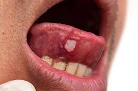 Image result for mouth ulcer on tongue)