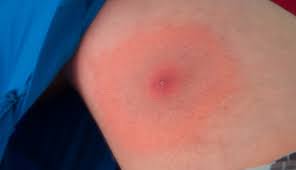 Lyme Disease Can 10 Minutes Make A Difference Clinical Advisor