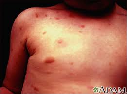 Image result for Urticaria pigmentosa children