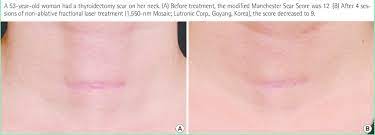 Fractional laser before and after scar. Nonablative Fractional Laser Download Scientific Diagram
