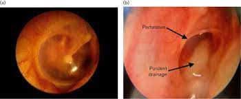 Chronic suppurative otitis media is a serious disease with a bacterial infection in the middle ear. Current Concepts In The Pathogenesis And Treatment Of Chronic Suppurative Otitis Media Abstract Europe Pmc