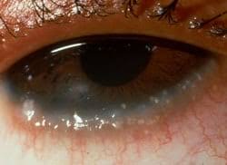 Image result for Allergic Conjunctivitis