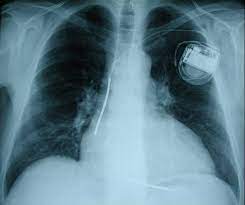 We did not find results for: Kardiologie Herzschrittmacher Defibrillatoren Kardiale Resynchronisations Therapie