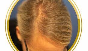 erfahrungsbericht eigenbluttherapie bei haarausfall