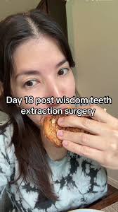 How Long Does It Take for Your Wisdom Teeth Holes to Fully Close