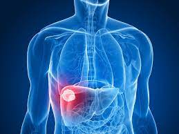 Liver Lesions Types Causes Diagnosis More