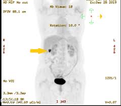 You need a comprehensive cancer center. Cureus Positron Emission Tomography With Fluorodeoxyglucose Incidental Detection Of Colon Cancer In A Patient S Follow Up For Nasopharyngeal Carcinoma During The Covid 19 Pandemic A Case Report