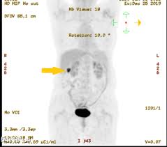 A pet scan is not specific for cancer. Cureus Positron Emission Tomography With Fluorodeoxyglucose Incidental Detection Of Colon Cancer In A Patient S Follow Up For Nasopharyngeal Carcinoma During The Covid 19 Pandemic A Case Report