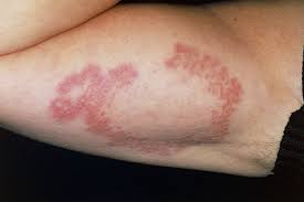 Small red dots on the skin may also occur when the blood sugar level is higher than normal. Pictures Of Skin Problems Linked To Diabetes