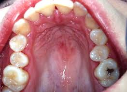 Image result for Erythroplakia roof of mouth
