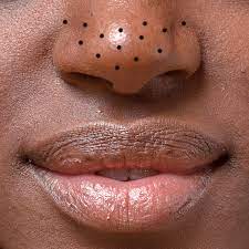 There are several surgical treatment options for rhinophyma, including: How To Get Rid Of Blackheads On Your Nose Chin And Forehead Self
