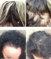 Wen hair care is enjoying a lot of success these days, with their products available at their official site, and through retailers like sephora. Pictures Show Damage Caused By Wen Hair Care After Company Agrees To Pay Out 20 000 Per User Daily Mail Online