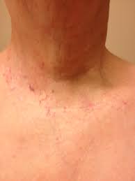 Cancer & cancer compatibility test. Anaplastic Thyroid Cancer Diagnosis