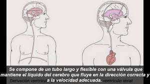El tratamiento quirúrgico para poder tratar la hidrocefalia se llama derivación ventriculoperitoneal y es una cirugía de neuro que ayuda a corregir el exceso de líquido cefalorraquídeo en las cavidades del cerebro; Tratamiento De La Hidrocefalia Youtube