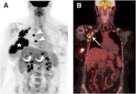 It can also show changes caused by other medical conditions. Retrospective Study Of 18f Fdg Pet Ct In The Diagnosis Of Inflammatory Breast Cancer Preliminary Data Journal Of Nuclear Medicine