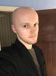 Hair loss in your 20s and 30s few people expect hair loss to happen as early as their 20s or 30s. I M 20 Years Old Have Been Losing My Hair Since My Early Teens Just Recently I Decided I Would Just Shave It Off I Like It Who Needs Hair Tressless