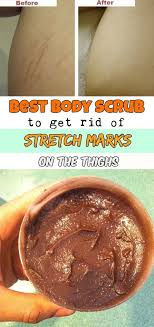 One way to prevent them is to incorporate one of the best body scrubs for ingrown hairs into your body care regimen. Best Body Scrub To Get Rid Of Stretch Marks On The Thighs Best Body Scrub Diy Stretch Marks Cream Stretch Marks