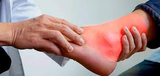 Icd 10 Codes For Gout Treatment And Symptoms Of Gouts Doccharge