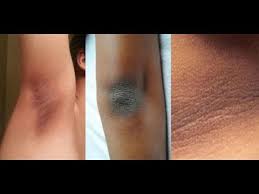 If the dark spots on your legs cause you any pain or discomfort, that is a sign of some underlying skin or medical condition and you should seek medical professional. How To Remove Dark Spots From Arms And Legs