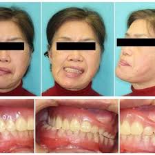 Pre-treatment extra oral photographs