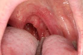 Maybe you would like to learn more about one of these? The Epidemiology Of Hypopharynx And Cervical Esophagus Cancer Hpv 16 Base Of Tongue Cancer