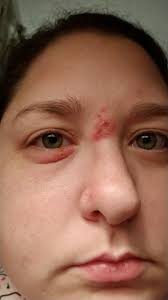 Infection of strep, staph and bacillis around eye and nose