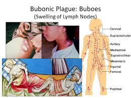 Occasionally, the swollen lymph nodes, known as buboes m. How To Diagnose A Medieval Disease Modern Plague Ppt Download