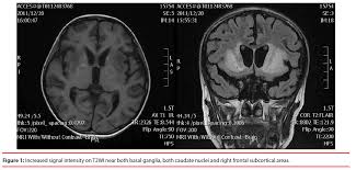 Kluver Bucy Syndrome Induced By Bilateral Basal Ganglion Lesion