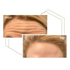 Maybe you would like to learn more about one of these? Botox Lewis Centre Oh Look Younger Relieve Pain Dermal Fillers