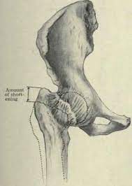 Check spelling or type a new query. Fractures Of The Femur