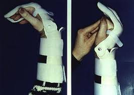 Flexor tendon, secondary reconstruction, zone ii, tendon graft, hunter rod. Flexor Tendon Injuries Orthoinfo Aaos