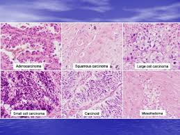 Epithelioid mesothelioma is a cancer caused by asbestos. Tumors Of Lung And Pleura Tumors Of The