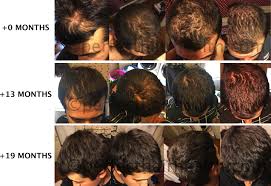 Additionally, it dilates the blood vessels under your skin, which, in turn, boosts hair growth. How To Do A Scalp Massage For Hair Growth
