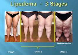 Understanding Lipedema And Empowering Our Patients Lymphatic Education Research Network In 2020 Lipedema Lymphedema Awareness Vein Clinic