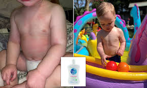 Baby eczema, medically known as atopic dermatitis, is a common skin condition that effects an estimated 10% of all children.if your baby is one of them, then you know how uncomfortable this dry, scaly, often itchy skin rash can be for little ones. Mother 27 Praises Miracle 4 99 Bubble Bath For Her Eczema Stricken Two Year Old Daily Mail Online