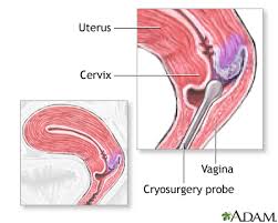 Image result for Friable Cervix