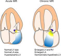 Mitral regurgitation is basically a leaky mitral valve. Acute Mitral Regurgitation Heart