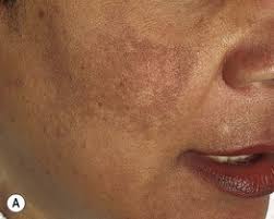 Image result for Diffuse Hyperpigmentation