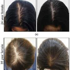 You probably know it as male pattern baldness. Pdf Combination Therapy To Treat Asian Female Pattern Hair Loss