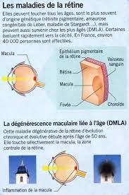Pour la forme humide de la. La Dmla Definition Symptomes Traitement Sciences Et Avenir